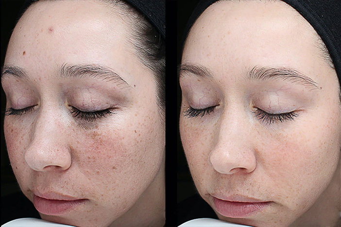 After and before VI Peel