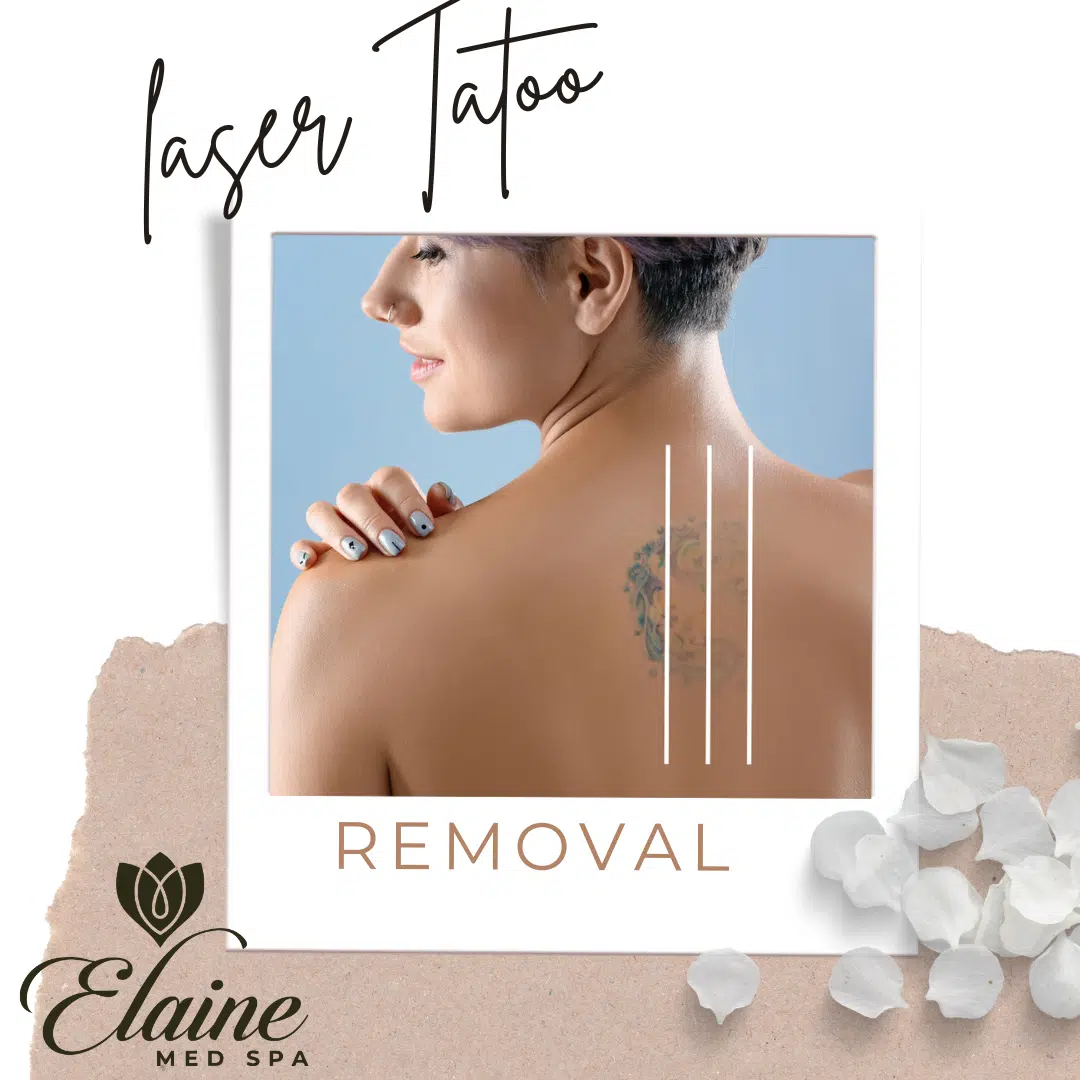 Tatoo laser removal